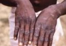 Deux cas de Monkeypox détectés au Cameroun alors que le virus se propage en Afrique centrale