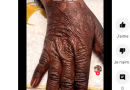 La main abimée de cette fille de 19 ans causée par le « Khessal » fait le buzz (vidéo)