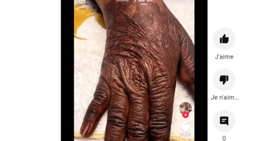 La main abimée de cette fille de 19 ans causée par le « Khessal » fait le buzz (vidéo)